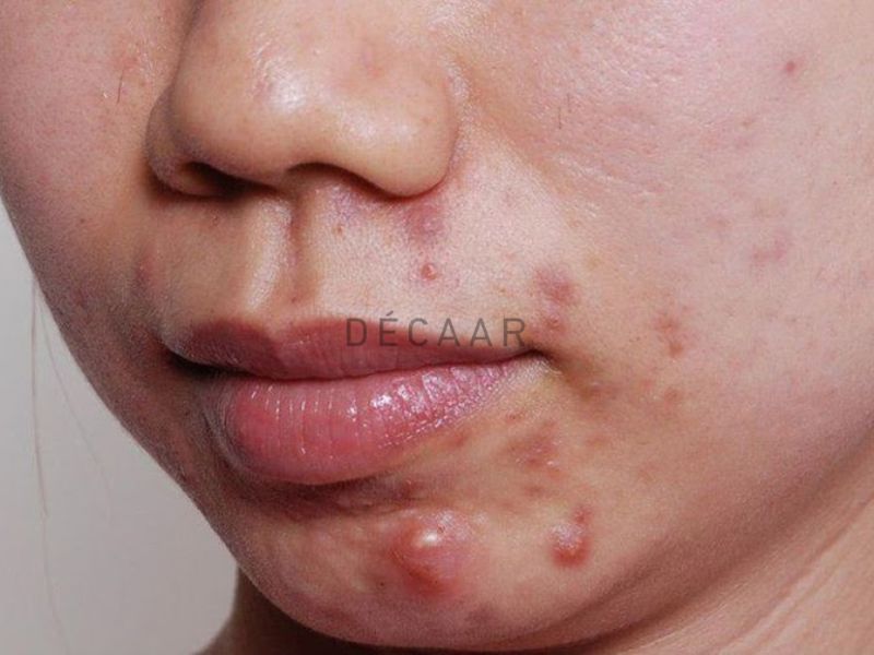 Thói quen sinh hoạt và làm việc thiếu khoa học gây nên tình trạng mụn